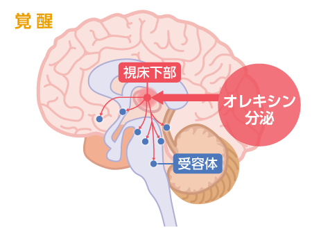 ナルコプレシータイプ１